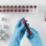 Come si diagnostica il lupus? I test e i sintomi